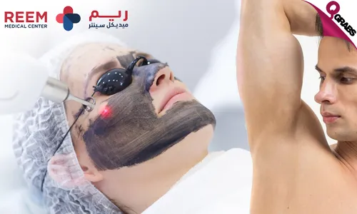 Carbon Laser Treatment for Face & Underarms at Reem Medical Center!
